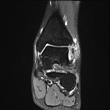 Ankle syndesmotic injury (Radiopaedia 69066-78837 Coronal PD fat sat 35).jpg