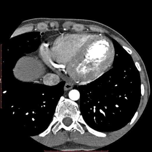 File:Anomalous left coronary artery from the pulmonary artery (ALCAPA) (Radiopaedia 70148-80181 A 307).jpg