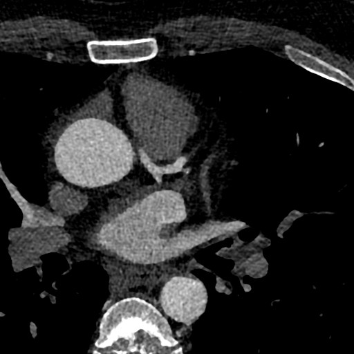 File:Anomalous origin of the left coronary artery with malignant course (Radiopaedia 77842-90126 C 19).jpeg