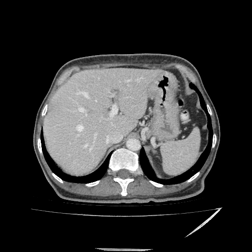Anorectal carcinoma (Radiopaedia 44413-48064 A 11).jpg