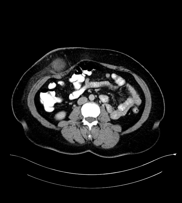 Anterior abdominal wall CSF pseudocyst (CSFoma) (Radiopaedia 79453-92571 A 50).jpg