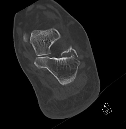 Anterior calcaneal process fracture (Radiopaedia 63353-71943 Axial bone window 99).jpg