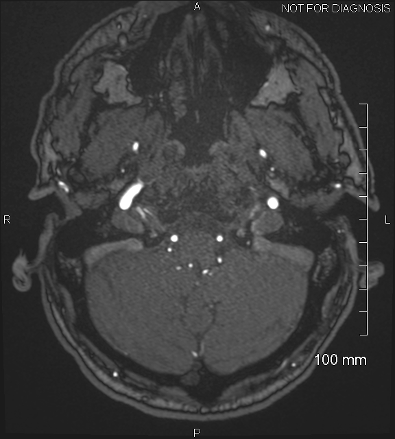 Anterior cerebral artery aneurysm (Radiopaedia 80683-94127 Axial MRA 25).jpg