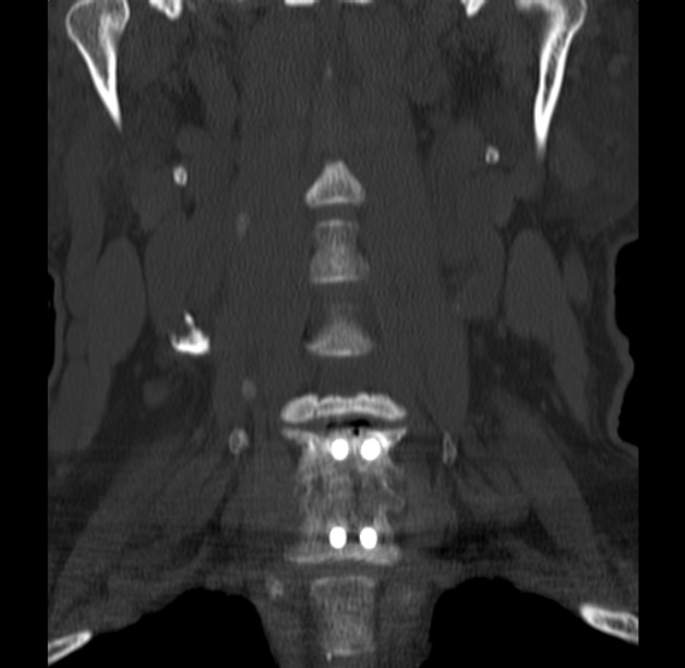 Anterior cervical postdiscectomy arthrodesis (Radiopaedia 32678-33646 Coronal bone window 14).jpg