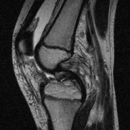 File:Anterior cruciate ligament avulsion fracture (Radiopaedia 24710-24974 Sagittal T2 6).jpg