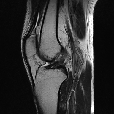 File:Anterior cruciate ligament full thickness tear (Radiopaedia 66268-75467 Sagittal T2 13).jpg