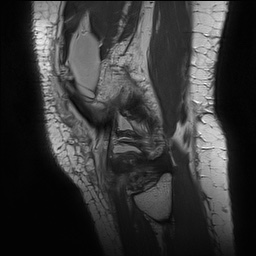 Anterior cruciate ligament rupture with Segond fracture (Radiopaedia 69043-78806 Sagittal PD 163).jpg