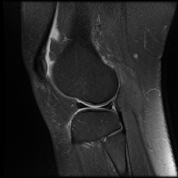 File:Anterior cruciate ligament tear, Wrisberg rip and bucket-handle tear of medial meniscus (Radiopaedia 75872-87266 Sagittal PD fat sat 6).jpg
