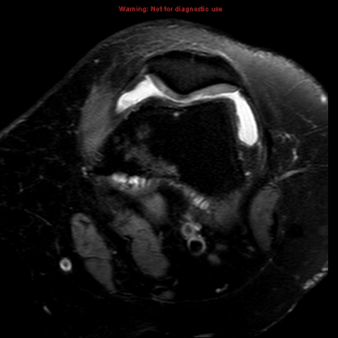 File:Anterior cruciate ligament tear (Radiopaedia 12329-12612 Axial T2 fat sat 17).jpg