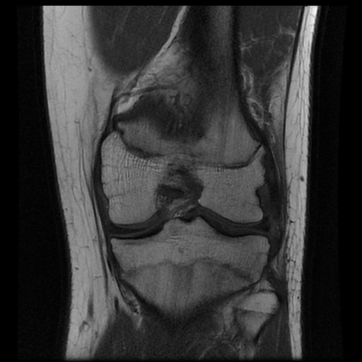 File:Anterior cruciate ligament tear (Radiopaedia 61500-69462 Coronal T1 13).jpg