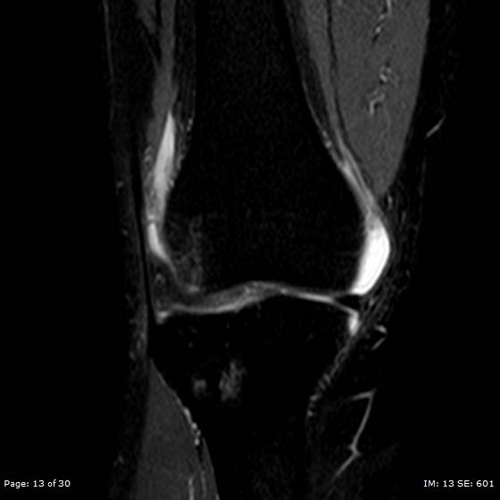 File:Anterior cruciate ligament tear (Radiopaedia 70783-80964 Coronal STIR 13).jpg