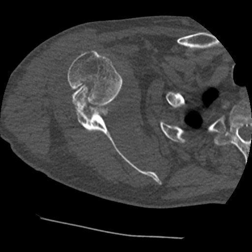 File:Anterior glenohumeral dislocation with Hill-Sachs lesion (Radiopaedia 62877-71249 Axial bone window 41).jpg
