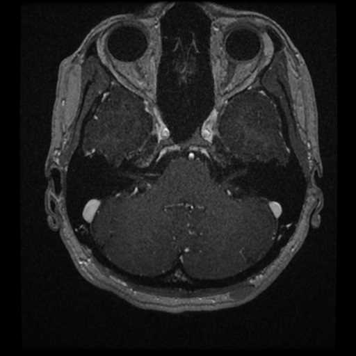 Anterior inferior cerebellar artery vascular loop - type II (Radiopaedia 70991-81209 Axial T1 C+ 49).jpg