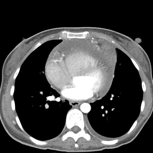 Anterior mediastinal lymphoma (Radiopaedia 29556-30061 C 35).jpg