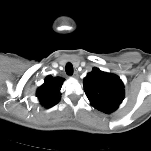 File:Anterior mediastinal lymphoma (Radiopaedia 29556-30061 C 7).jpg