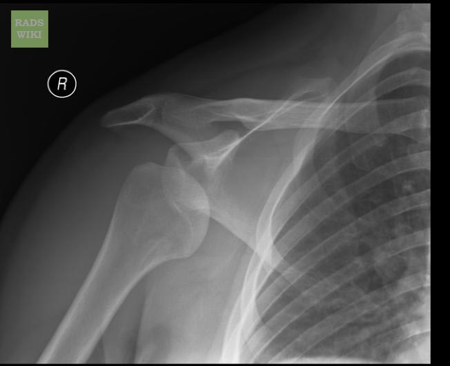 File:Anterior shoulder dislocation (Radiopaedia 11194-11558 Frontal 1).jpg