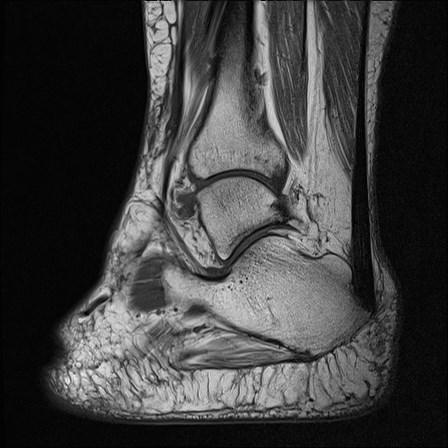 File:Anterior talofibular ligament injury - rupture with soft-tissue impingement (Radiopaedia 38765-40928 Sagittal PD 14).jpg