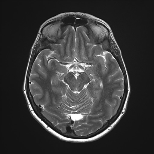 File:Anterior temporal encephalocele (Radiopaedia 82624-96808 Axial T2 15).jpg
