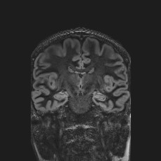 Anterior temporal encephalocele (Radiopaedia 82624-96808 Coronal FLAIR 26).jpg