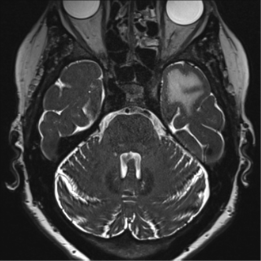 Anterior temporal pole cysts (Radiopaedia 46629-51102 Axial T2 49).png