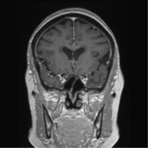 Anterior temporal pole cysts (Radiopaedia 46629-51102 Coronal T1 C+ 115).png