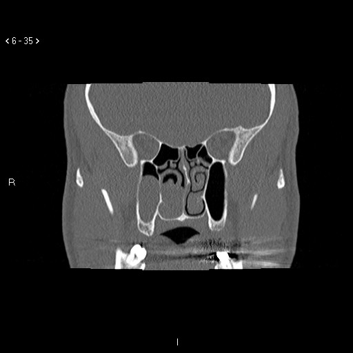 File:Antrochoanal Polyp (Radiopaedia 70510-80631 Coronal bone window 24).jpg