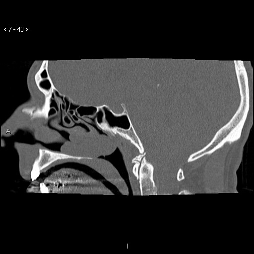 File:Antrochoanal Polyp (Radiopaedia 70510-80631 Sagittal bone window 33).jpg