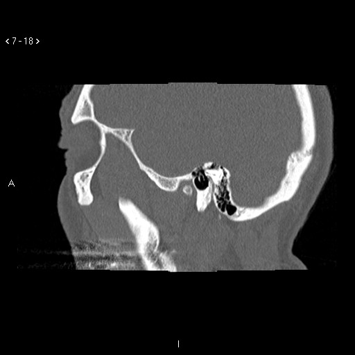 File:Antrochoanal Polyp (Radiopaedia 70510-80631 Sagittal bone window 8).jpg