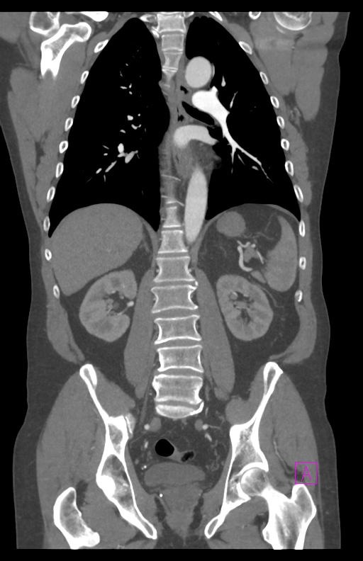 Aortectomy and axillary-bifemoral bypass (Radiopaedia 28303-28545 C 58).jpg