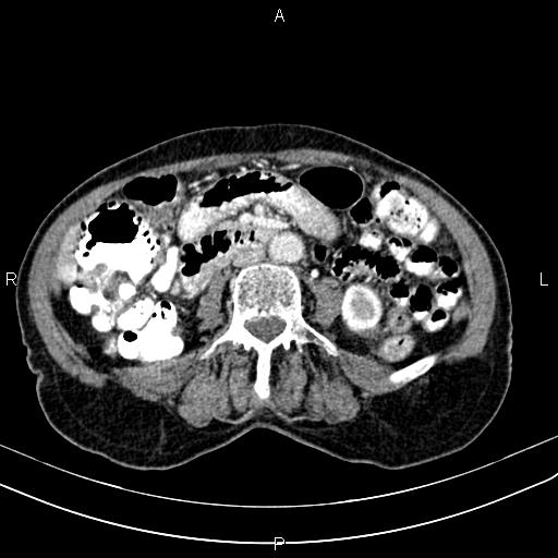 File:Aortic aneurysm and Lemmel syndrome (Radiopaedia 86499-102554 A 44).jpg