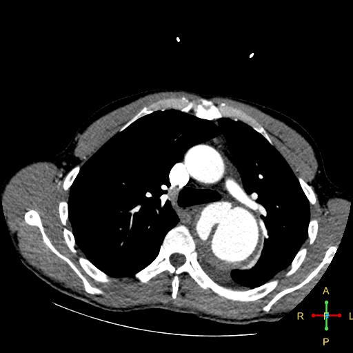 File:Aortic aneurysm and penetrating ulcer (Radiopaedia 23590-23704 A 12).jpg