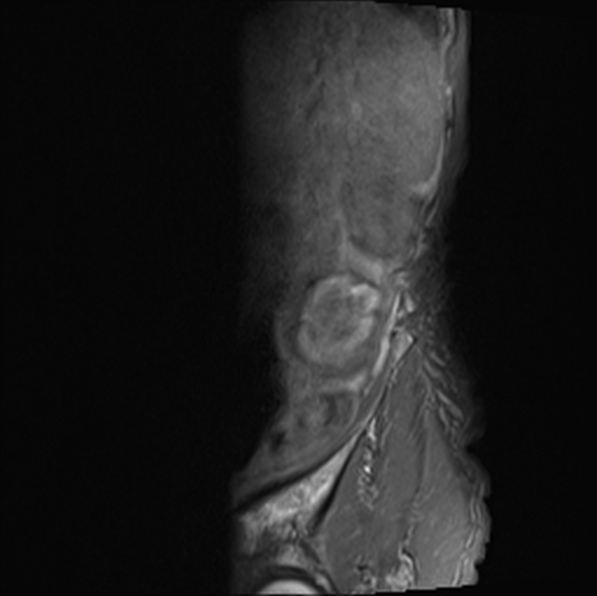 File:Aortic aneurysm with spinal destruction (Radiopaedia 42301-45409 Sagittal T1 fat sat 3).jpg