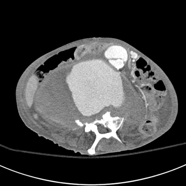 File:Aortic aneurysm with spinal destruction (Radiopaedia 42301-45410 A 54).jpg