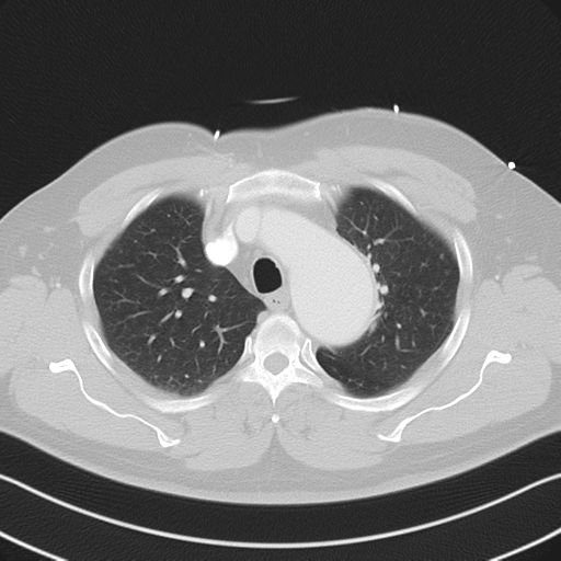 File:Aortic dissection (Radiopaedia 50763-56234 Axial lung window 22).png