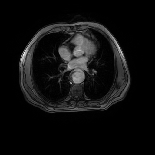 Aortic dissection - Stanford A - DeBakey I (Radiopaedia 23469-23551 Axial MRA 21).jpg