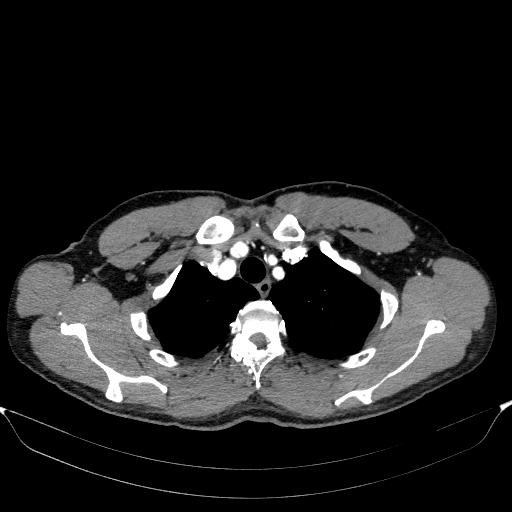 Aortic dissection - Stanford type A (Radiopaedia 83418-98500 A 11).jpg