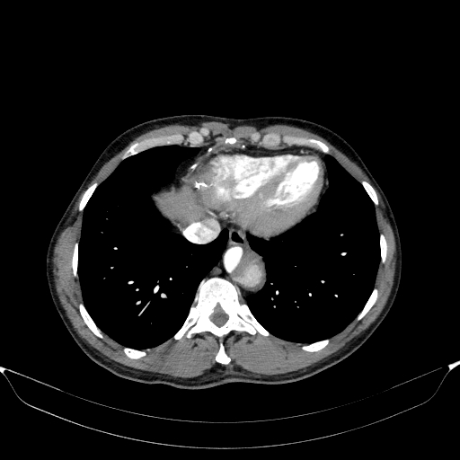 Aortic dissection - Stanford type A (Radiopaedia 83418-98500 A 50).jpg