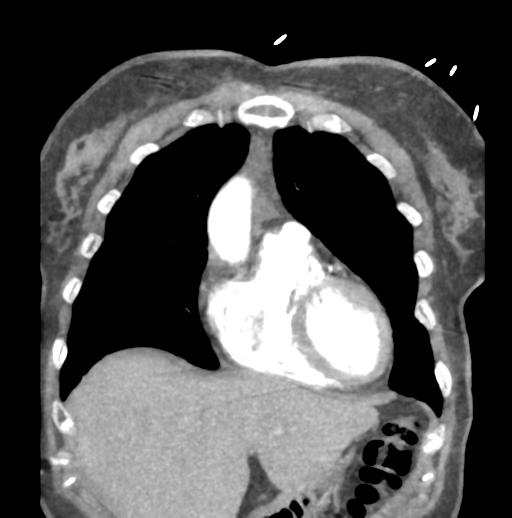 File:Aortic dissection - Stanford type B (Radiopaedia 50171-55512 B 21).png