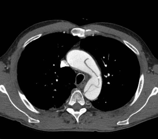 File:Aortic dissection - Stanford type B (Radiopaedia 73648-84437 A 25).jpg