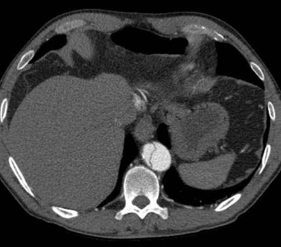 Aortic dissection - Stanford type B (Radiopaedia 73648-84437 A 97).jpg