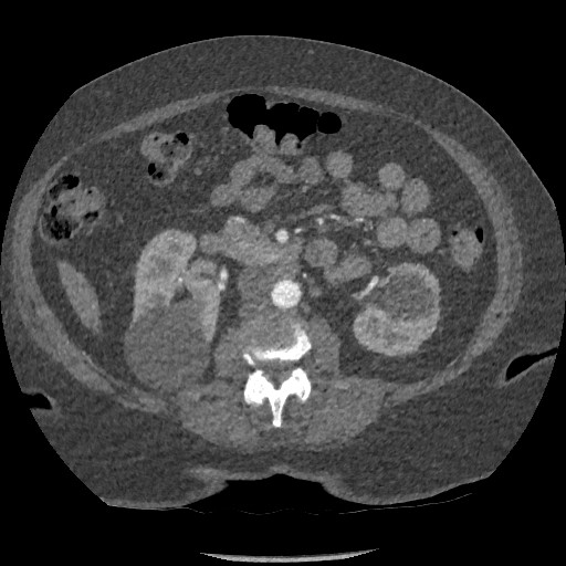 File:Aortic dissection - Stanford type B (Radiopaedia 88281-104910 A 119).jpg