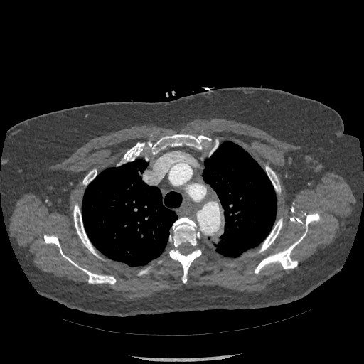 Aortic dissection - Stanford type B (Radiopaedia 88281-104910 A 14).jpg