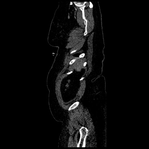 File:Aortic dissection - Stanford type B (Radiopaedia 88281-104910 C 80).jpg