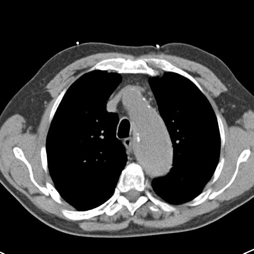 File:Aortic intramural hematoma (Radiopaedia 31139-31838 Axial non-contrast 17).jpg