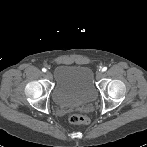 File:Aortic intramural hematoma (Radiopaedia 31139-31838 B 161).jpg