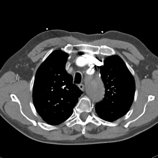 Aortic intramural hematoma (Radiopaedia 31139-31838 B 23).jpg