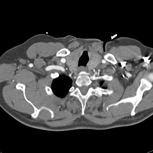 Aortic intramural hematoma (Radiopaedia 31139-31838 B 8).jpg