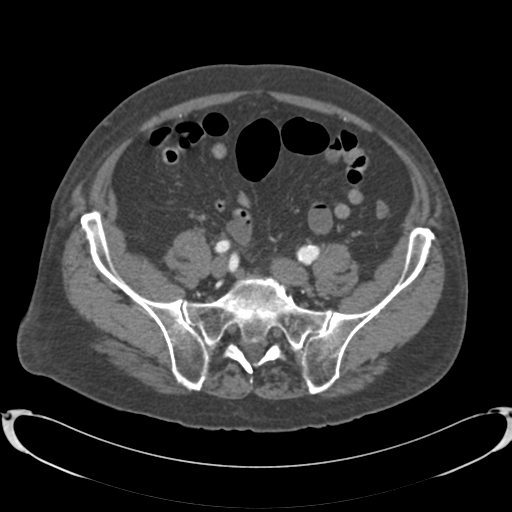 Aortic intramural hematoma (Radiopaedia 34260-35540 B 75).png