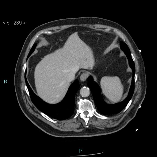 File:Aortic intramural hematoma (Radiopaedia 48463-53380 C 129).jpg