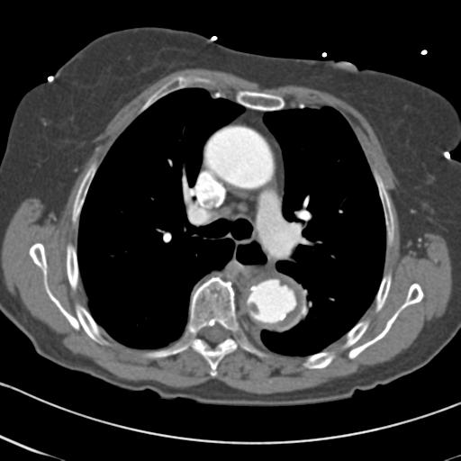 Aortic intramural hematoma from penetrating atherosclerotic ulcer (Radiopaedia 31137-31836 A 31).jpg